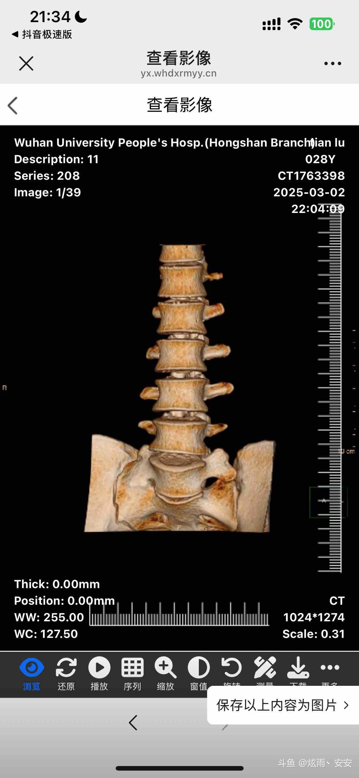 检查结果,腰椎骶化导致腰椎那个位置一动都是疼的,医生说要么是腰受过